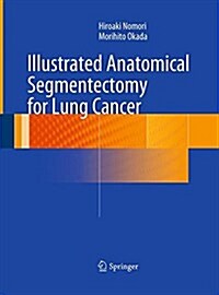 Illustrated Anatomical Segmentectomy for Lung Cancer (Paperback, Softcover Repri)