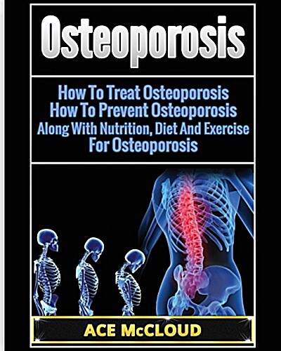 Osteoporosis: How to Treat Osteoporosis: How to Prevent Osteoporosis: Along with Nutrition, Diet and Exercise for Osteoporosis (Paperback)