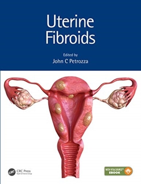 Uterine Fibroids (Hardcover)