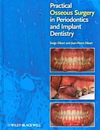 Practical Osseous Surgery in Periodontics and Implant Dentistry (Hardcover)