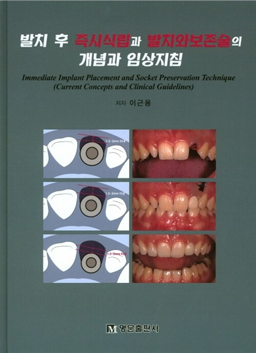 발치 후 즉시식립과 발치와보존술의 개념과 임상지침