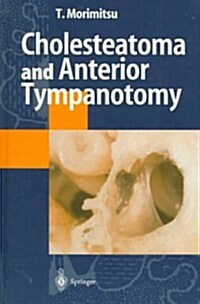 Cholesteatoma and Anterior Tympanotomy (Hardcover)