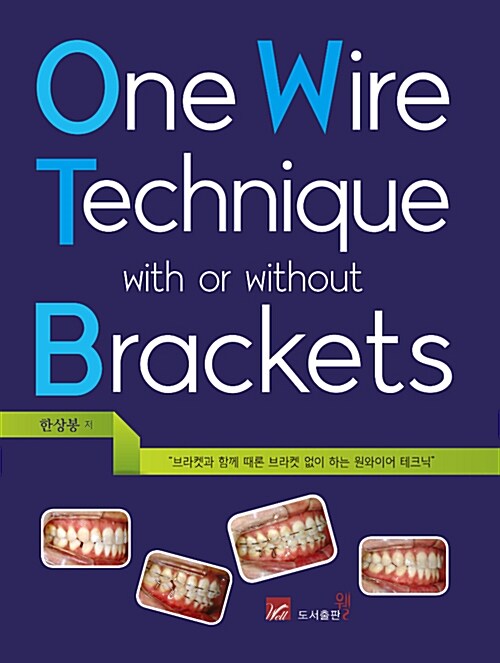 One Wire Technique with on without Brackets