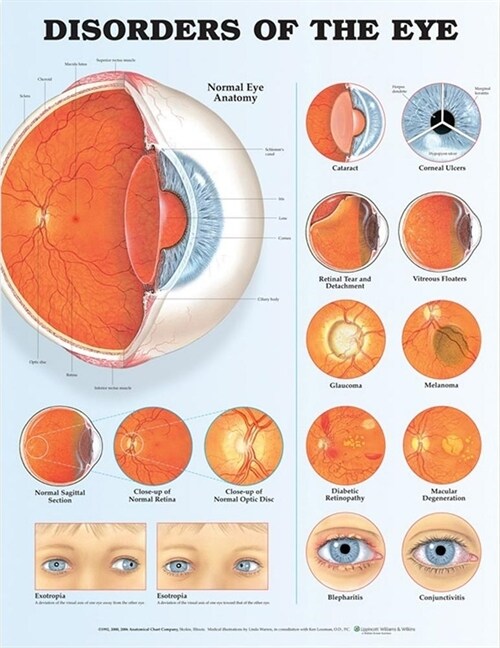 Disorders of the Eye Anatomical Chart (Other, 2)
