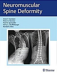 Neuromuscular Spine Deformity (Hardcover)