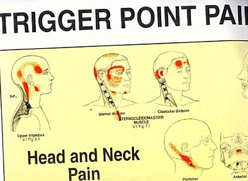 Travell and Simons Trigger Point Pain Patterns Wall Charts (Paperback)