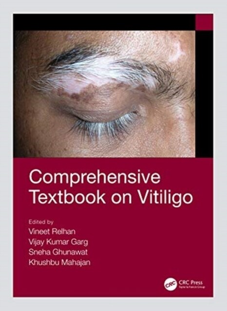 Comprehensive Textbook on Vitiligo (Hardcover)