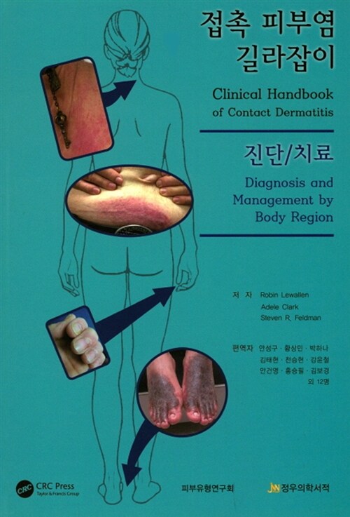 접촉 피부염 길라잡이