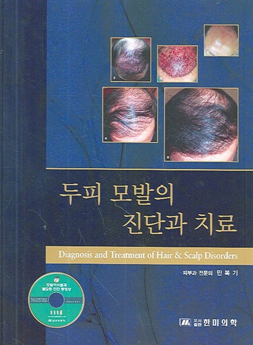 두피 모발의 진단과 치료