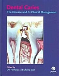 Dental Caries (Hardcover, Illustrated)