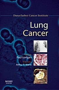 Lung Cancer (Paperback, 1st)