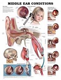 Middle Ear Conditions Chart (Chart, 1st)