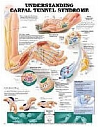 Understanding Carpal Tunnel Syndrome Anatomical Chart (Hardcover)