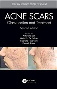 Acne Scars : Classification and Treatment, Second Edition (Hardcover, 2 ed)