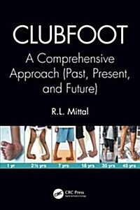 Clubfoot : A Comprehensive Approach (Past, Present, and Future) (Hardcover)