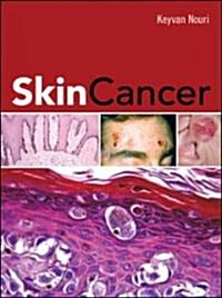 Skin Cancer (Hardcover, 1st)