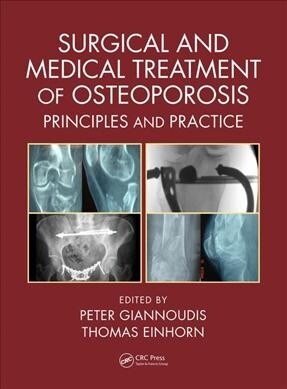 Surgical and Medical Treatment of Osteoporosis: Principles and Practice (Hardcover)
