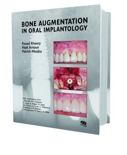 Bone Augmentation in Oral Implantology (Hardcover)