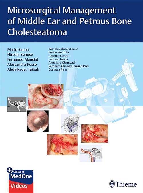 Microsurgical Management of Middle Ear and Petrous Bone Cholesteatoma (Hardcover)