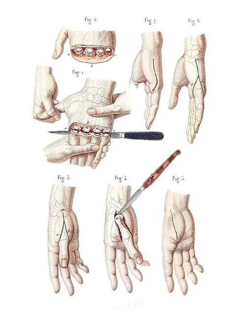 Disarticulation of the Four Fingers and of the Thumb Composition Notebook: Wide Ruled Note-Taking Book (Paperback)