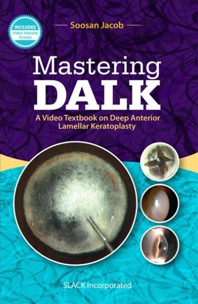 Mastering Dalk: A Video Textbook on Deep Anterior Lamellar Keratoplasty (Paperback)