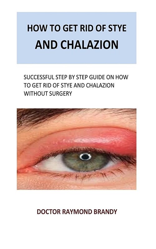 How to Get Rid of Stye and Chalazion: Successful Step by Step Guide on How to Get Rid of Stye and Chalazion Without Surgery (Paperback)