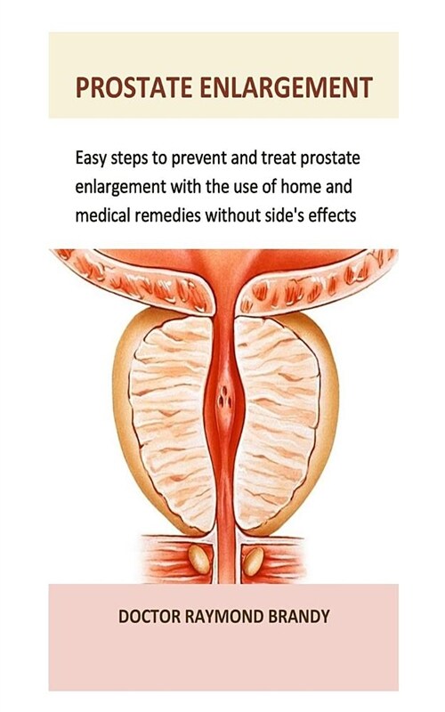 Prostate Enlargement: Easy Steps to Prevent and Treat Prostate Enlargement with the Use of Home and Medical Remedies Without Sides Effects (Paperback)