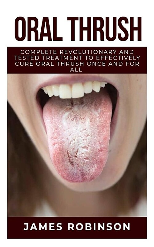 Oral Thrush: Complete Revolutionary and Tested Treatment to Effectively Cure Oral Thrush Once and for All (Paperback)