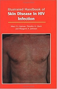 Illustrated Handbook of Skin Disease in HIV Infection (Paperback, POC)