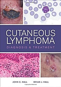 Cutaneous Lymphoma (Hardcover, 1st)