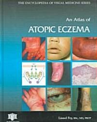 An Atlas of Atopic Eczema (Hardcover)