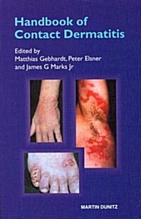 Handbook of Contact Dermatitis (Paperback)