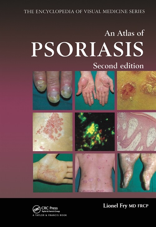 An Atlas of Psoriasis, Second Edition (Hardcover, 2 ed)