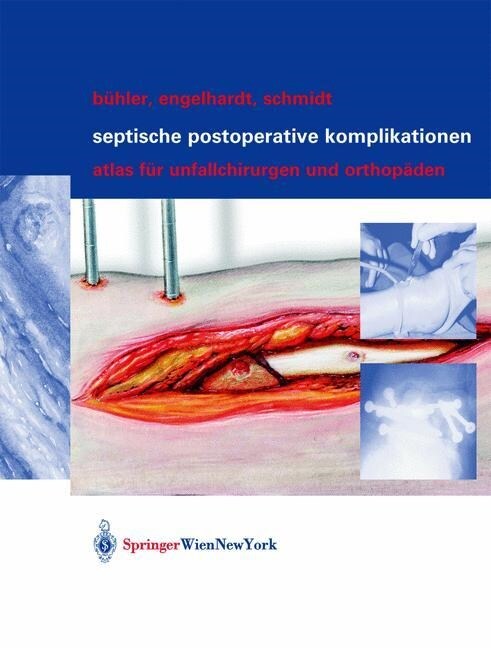 Septische postoperative Komplikationen : Atlas fur Unfallchirurgen und Orthopaden (Paperback)