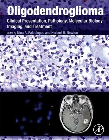 Oligodendroglioma: Clinical Presentation, Pathology, Molecular Biology, Imaging, and Treatment (Hardcover)