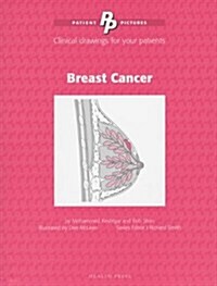 Patient Pictures: Breast Cancer : Clinical drawings for your patients Illustrated by Dee McLean. (Spiral Bound)