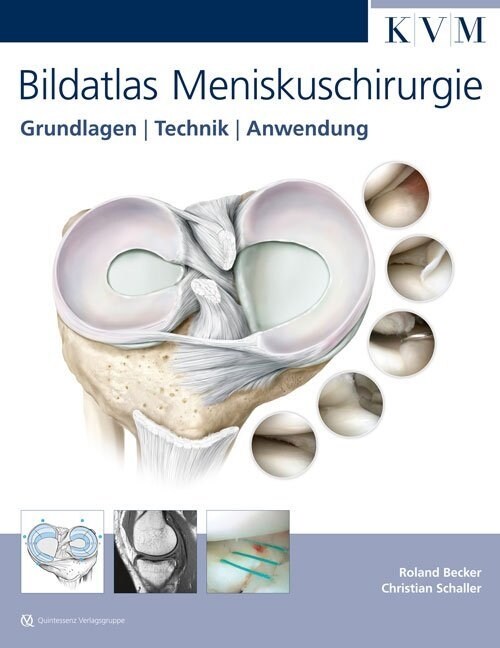 Bildatlas Meniskuschirurgie (Hardcover)