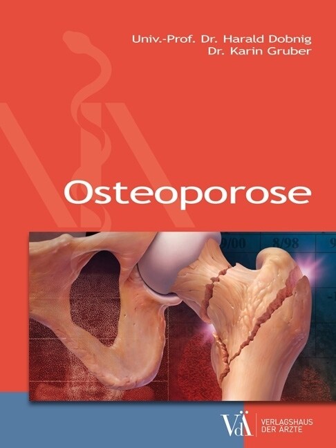 Osteoporose (Paperback)