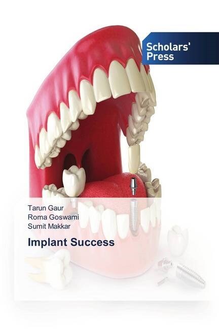 Implant Success (Paperback)