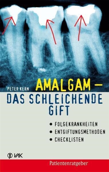 Amalgam - das schleichende Gift (Paperback)