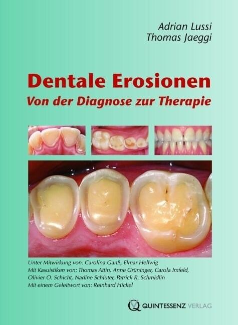 Dentale Erosionen (Hardcover)