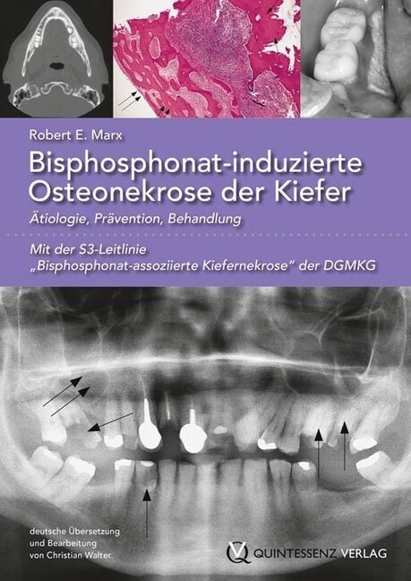 Bisphosphonat-induzierte Osteonekrose der Kiefer (Paperback)