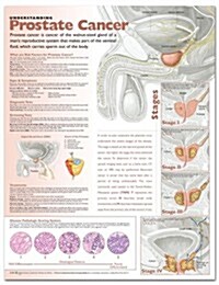 Understanding Prostate Cancer Anatomical Chart (Paperback, 1st, LAM, Wall)