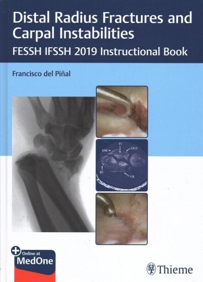 Distal Radius Fractures and Carpal Instabilities: Fessh Ifssh 2019 Instructional Book (Hardcover)