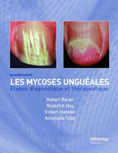 Onychomycosis/Les Mycoses Ungueales (Hardcover)