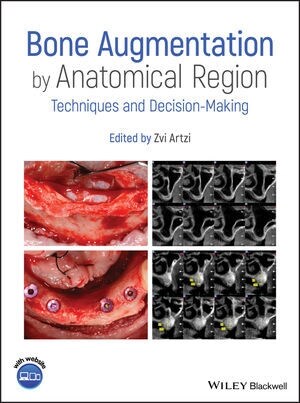 Bone Augmentation by Anatomical Region: Techniques and Decision-Making (Hardcover)