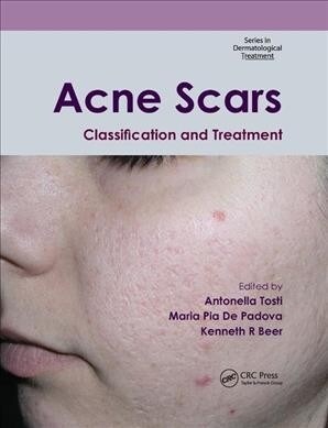 Acne Scars : Classification and Treatment (Paperback)