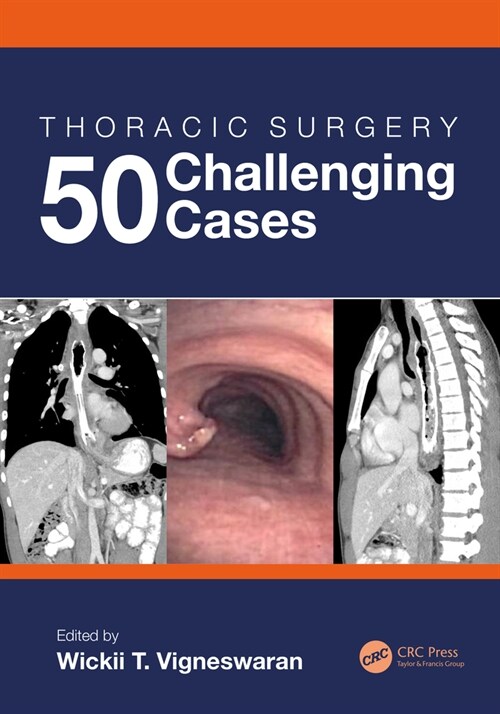 Thoracic Surgery: 50 Challenging cases (Hardcover)