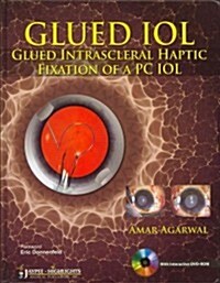 Glued IOL (Hardcover, DVD-ROM, 1st)