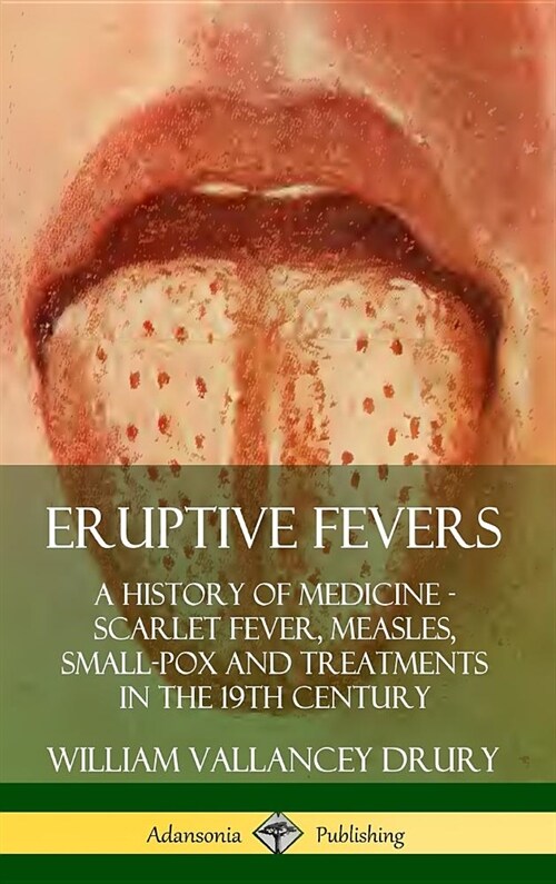 Eruptive Fevers: A History of Medicine - Scarlet Fever, Measles, Small-Pox and Treatments in the 19th Century (Hardcover) (Hardcover)